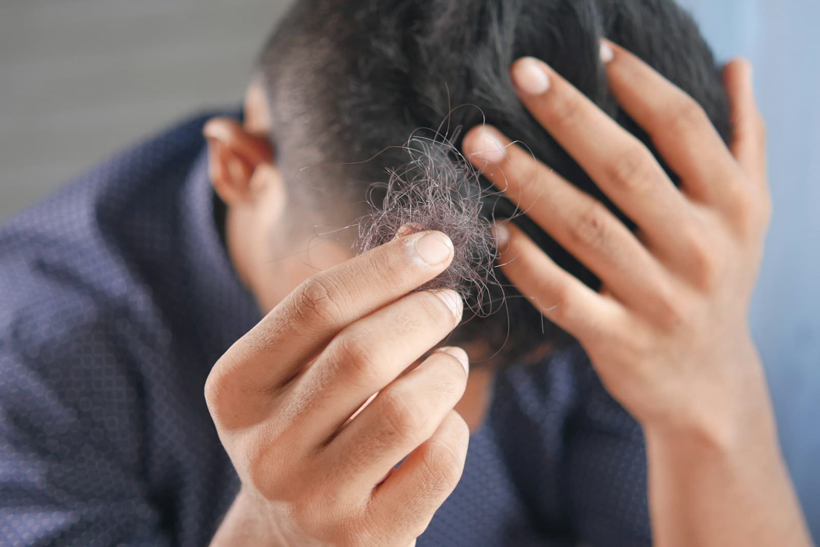 Homem segurando fios de cabelo que caíram